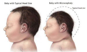 引發「小頭畸形症」，正常嬰兒的頭型(左)，患病嬰兒的頭型(右)p1094-a1-09