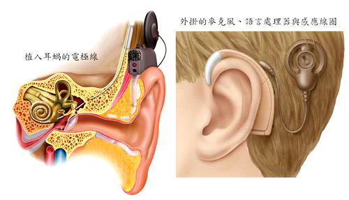戴人工電子耳p1150-a6-03C